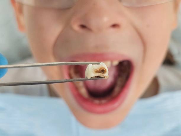 Best Emergency Wisdom Tooth Extraction in Satsuma, AL